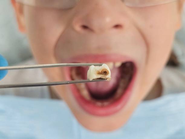 Best Broken or Chipped Tooth Repair in Hyrum, UT